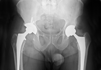 DePuy ASR Hip Replacement Trial Scheduled to Begin on January 22, 2013 in California Superior Court