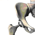 Biomedical Engineer Delivers Testimony in California DePuy ASR Hip Trial: Hip Implant Designed with Life-Threatening Defects